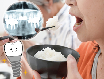 インプラントイメージ